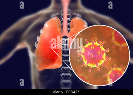 MERS virus infection of lungs, conceptual illustration. MERS (Middle East respiratory syndrome) is a viral respiratory illness caused by the MERS-associated coronavirus (MERS-CoV). Formerly known as novel coronavirus, MERS was first identified in Saudi Arabia in 2012. Most people infected with MERS develop severe acute respiratory illness with symptoms of fever, cough, and shortness of breath. Stock Photo