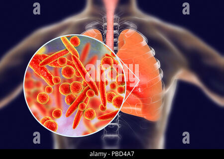 Pneumonia caused by Mycoplasma pneumoniae bacteria, conceptual computer illustration. Stock Photo