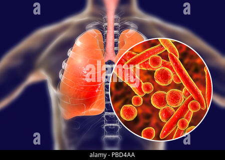 Pneumonia caused by Mycoplasma pneumoniae bacteria, conceptual computer illustration. Stock Photo