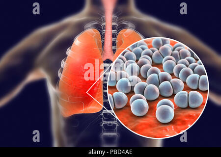 Pneumonia caused by Streptococcus pneumoniae bacteria, conceptual computer illustration. S. pneumoniae bacteria are Gram-positive diplococci (arranged in pairs), they are the main cause of community acquired pneumonia in children and the elderly. Stock Photo