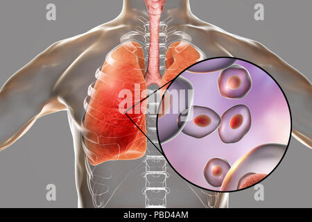 Pneumocystis pneumonia, conceptual computer illustration. This lung infection is the most common opportunistic illness in people infected with HIV (Human Immunodeficiency Virus) and is caused by the fungus Pneumocystis jaroveci (previously P. carinii). Treatment involves the use of antibiotics and bed rest. Stock Photo