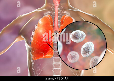 Pneumocystis pneumonia, conceptual computer illustration. This lung infection is the most common opportunistic illness in people infected with HIV (Human Immunodeficiency Virus) and is caused by the fungus Pneumocystis jaroveci (previously P. carinii). Treatment involves the use of antibiotics and bed rest. Stock Photo