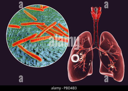 Fibrous-cavernous pulmonary tuberculosis and close-up view of Mycobacterium tuberculosis bacteria, the causative agent of tuberculosis. Computer illustration showing cavern (cavity) in the right lung with a well-formed fibrous layer in its wall. Stock Photo