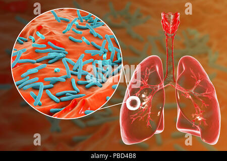 Fibrous-cavernous pulmonary tuberculosis and close-up view of Mycobacterium tuberculosis bacteria, the causative agent of tuberculosis. Computer illustration showing cavern (cavity) in the right lung with a well-formed fibrous layer in its wall. Stock Photo