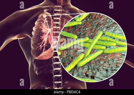 Secondary tuberculosis infection and close-up view of Mycobacterium tuberculosis bacteria, the causative agent of tuberculosis. Computer illustration showing small-sized solid nodular mass located in the upper lobe of right lung near lung apex. Stock Photo