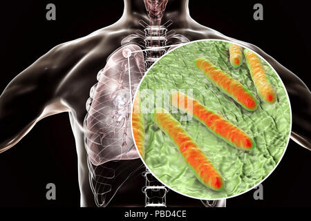 Secondary tuberculosis infection and close-up view of Mycobacterium tuberculosis bacteria, the causative agent of tuberculosis. Computer illustration showing small-sized solid nodular mass located in the upper lobe of right lung near lung apex. Stock Photo