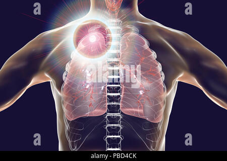 Secondary tuberculosis infection and close-up view of Mycobacterium tuberculosis bacteria, the causative agent of tuberculosis. Computer illustration showing small-sized solid nodular mass located in the upper lobe of right lung near lung apex. Stock Photo