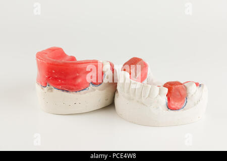 wax rollers on the tooth model for determining jaw closure Stock Photo