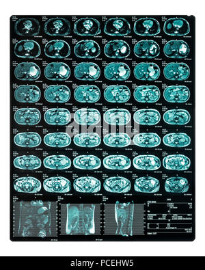 MRI Scan. MR Enterography of the small intestine a noninvasive medical test used to diagnose medical conditions of the bowels, like Crohn's disease Stock Photo