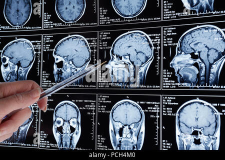Magnetic resonance scan of the brain. MRI head scan. Stock Photo