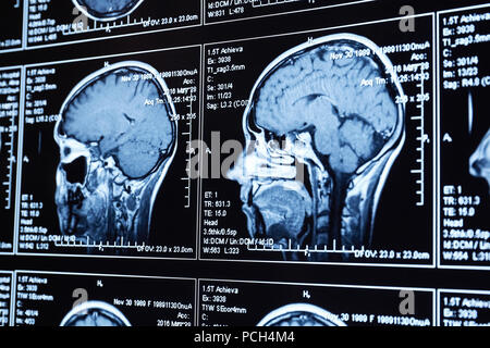 Magnetic resonance scan of the brain. MRI head scan. Stock Photo