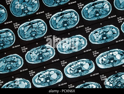 MRI Scan, Close Up. MR Enterography of the small intestine a noninvasive medical test used to diagnose medical conditions of the bowels, like Crohn's  Stock Photo