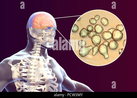 Meningitis caused by fungi Cryptococcus neoformans, computer illustration. C. neoformans is a yeast-like fungus that reproduces by budding. An acidic mucopolysaccharide capsule completely encloses the fungus. It can cause the disease cryptococcosis, especially in immune deficient patients, such as those with AIDS (acquired immunodeficiency syndrome). The infection may cause meningitis, and may also be located in the lungs, skin or other body regions. The most common clinical form is meningoencephalitis. Stock Photo