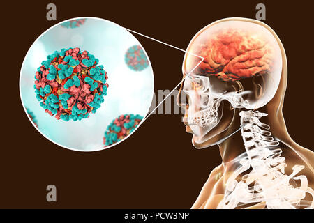 Venezuelan equine encephalitis viruses infecting human brain, computer illustration. This mosquito-borne virus can cause fatal brain and spinal cord inflammation in horses. It can also cause a fatal fever in humans. In viruses, the capsid is the protein shell that encloses the genetic material. A capsid consists of subunits called capsomeres that self-assemble to form the shell seen here. One of the functions of the capsid is to aid the transmission of the viral genetic material into host cells. Stock Photo