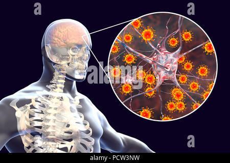 Viral encephalitis. Conceptual illustration showing brain with signs of encephalitis inside human body and close-up view of viruses. Stock Photo