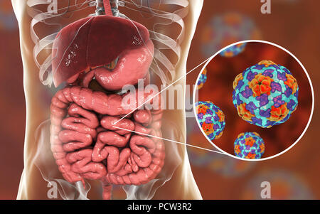 Hepatitis A viruses infecting intestine, illustration. Hepatitis A is transmitted through infected food or drink. Symptoms include influenza-like symptoms of fever and sickness, along with jaundice. Stock Photo