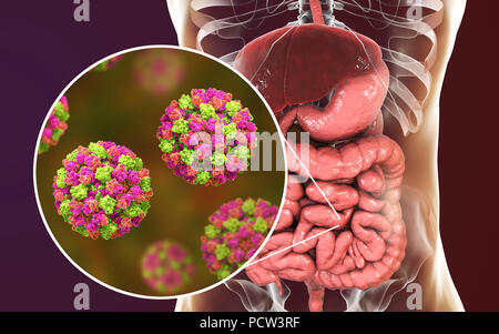 Norovirus infection, computer illustration. Norovirus is a genus of RNA (ribonucleic acid) viruses (of the family Caliciviridae), which cause about half of all gastroenteritis cases around the world. The disease is characterised by nausea, vomiting, diarrhoea and abdominal pain. The diarrhoea results in fluid loss and dehydration, which may become life-threatening in the young, the elderly, and the immunocompromised if not treated promptly. Stock Photo