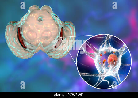 Substantia nigra. Computer illustration showing a degenerated substantia nigra in Parkinson's disease. The substantia nigra plays an important role in reward, addiction, and movement. Degeneration of this structure is characteristic of Parkinson's disease. In Parkinson's neurons in the substantia nigra contain Lewy bodies, which are deposits of protein, shown here as small red spherical inclusions in the neuron's cytoplasm. Stock Photo