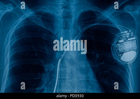 pacemaker cell x-ray image Stock Photo