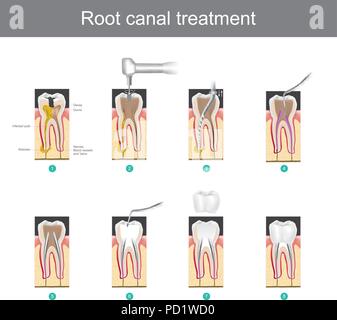 Root canal treatment. How to treat our teeth after the tooth is damaged. or severe caries as causes infection or inflammation Stock Vector