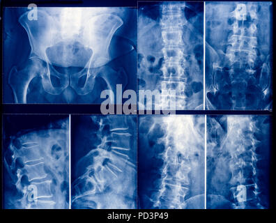 Blue coloured X-ray pictures of a human pelvis and spinal column Stock Photo