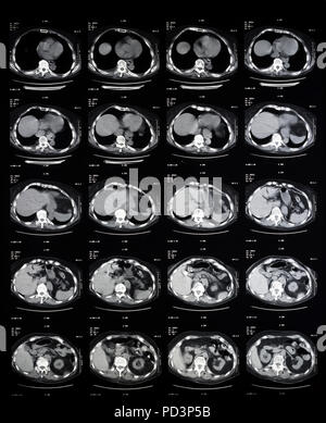 Sequence of horizontal sections of a female human brain, MRI scans ...