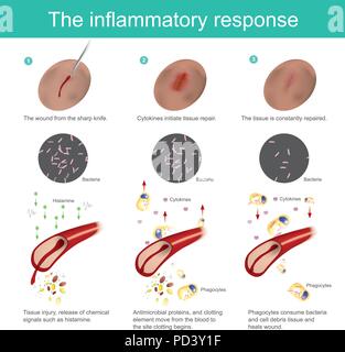 The inflammatory response. When the skin tissue is damaged, the body will produce immunity, eliminate bacteria, together with the new tissue regenerat Stock Vector
