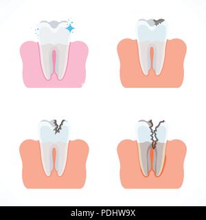 The stages of tooth decay / flat vector illustration Stock Vector Image ...