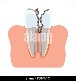 Stages of tooth decay with caries. Dentistry and oral care Stock Vector