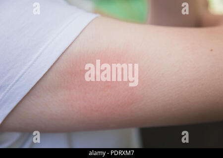 Woman Scratching an itch . Sensitive Skin, Food allergy symptoms ...