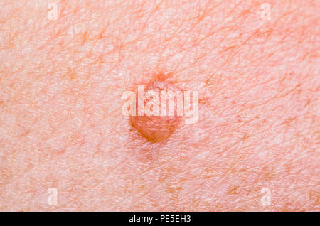 Skin Mole Defect High Magnification Macro Photo for Medical Diagnosis Stock Photo