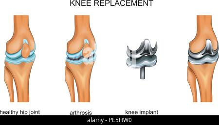 vector illustration of a total knee replacement Stock Vector
