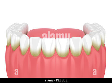 3d render of teeth with plaque and tartar over white background Stock Photo