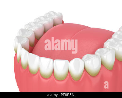 3d render of teeth with plaque and tartar over white background Stock Photo