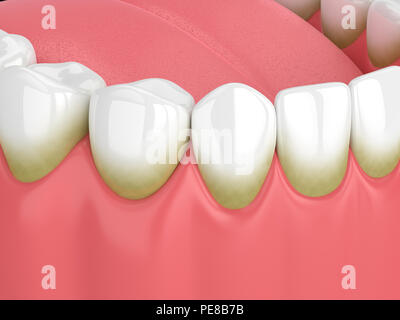 3d render of teeth with plaque and tartar over white background Stock Photo