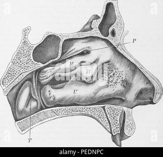 Black and white print depicting a left nasal cavity, with lumpy hyperplasia of the mucous membrane toward the anterior end of the middle turbinate and severe hyperplasia of the mucosa and polyps in the upper course, published in Albert Eulenburg's 'Real-Encyclopadie der gesammten Heilkunde; medicinisch-chirurgisches Handworterbuch fur praktische Arzte', 1885. Courtesy Internet Archive. () Stock Photo