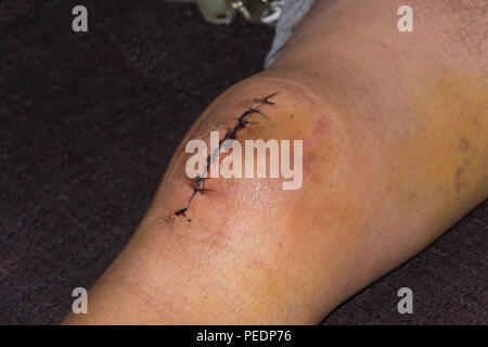 Male knee after surgical operation, knee replacement. Knee surgery in the hospital Stock Photo