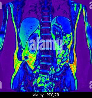 Frontal Abdomen MRI scan of a 60 year old male patient. This patient suffers from a kidney stone Stock Photo