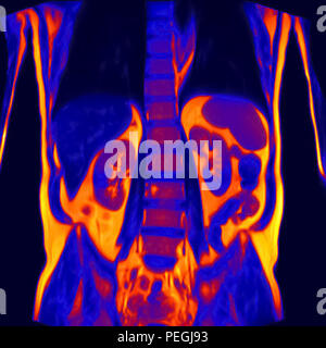 Frontal Abdomen MRI scan of a 60 year old male patient. This patient suffers from a kidney stone Stock Photo