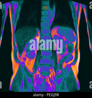 Frontal Abdomen MRI scan of a 60 year old male patient. This patient suffers from a kidney stone Stock Photo