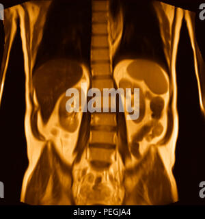 Frontal Abdomen MRI scan of a 60 year old male patient. This patient suffers from a kidney stone Stock Photo