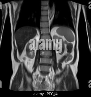 Frontal Abdomen MRI scan of a 60 year old male patient. This patient suffers from a kidney stone Stock Photo