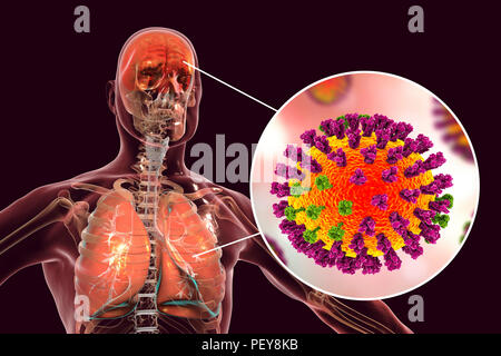 Computer illustrations showing the common complications of flu infection, such as encephalitis and pneumonia. Stock Photo