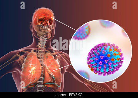 Computer illustrations showing the common complications of flu infection, such as encephalitis and pneumonia. Stock Photo