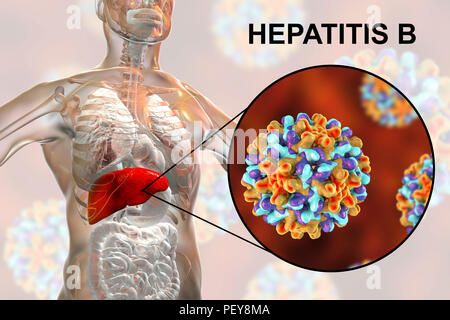 Hepatitis A infection. Computer illustration showing the liver and a  close-up view of hepatitis A viruses Stock Photo - Alamy