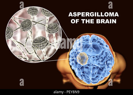 Aspergilloma of the brain and a close-up view of Aspergillus fungi, computer illustration. Also known as mycetoma, or fungus ball, this is an intracranial lesion produced by Aspergillus fungi in immunocompromised patients. Stock Photo