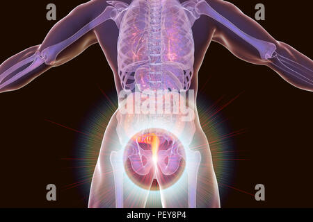 Haemorrhoids. Computer illustration of a rear view of the human body with external haemorrhoids in the anus. Stock Photo