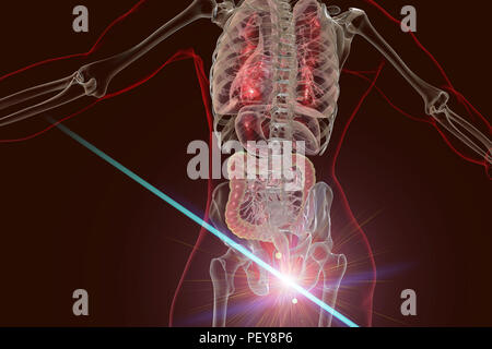 Laser treatment of haemorrhoids, conceptual computer illustration. Rear view of the human body with external haemorrhoids in the anus and removal of haemorrhoids by laser surgery. Stock Photo
