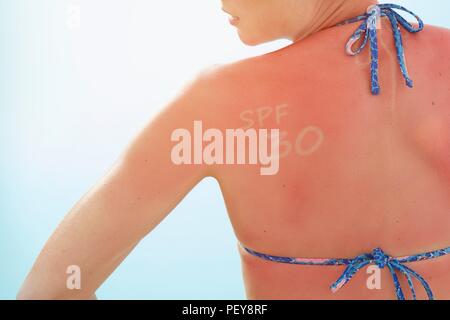 Woman with sunburnt back and 'SPF 30' written on her shoulder. Stock Photo