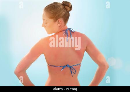 Woman with sunburnt back, rear view. Stock Photo